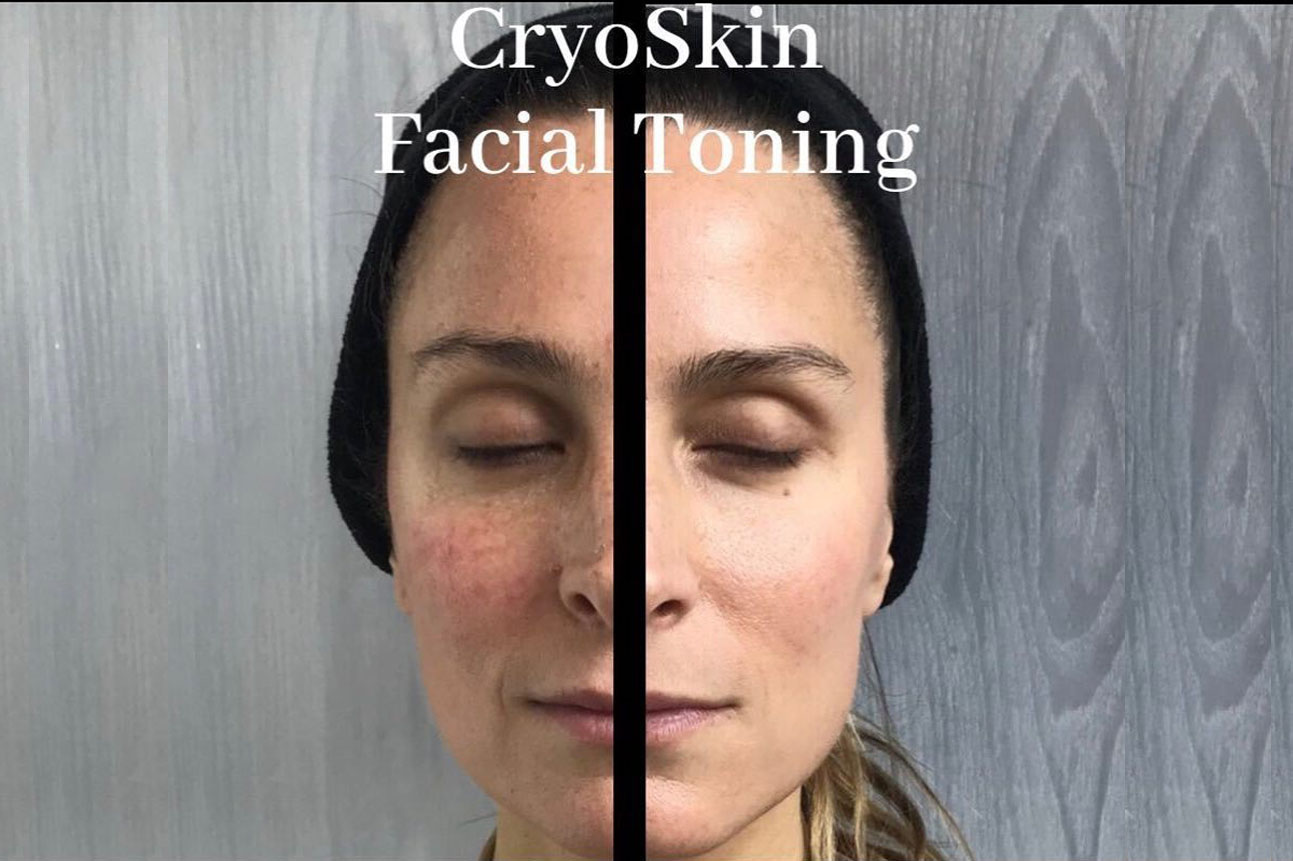 cryoskin facial toning before and after